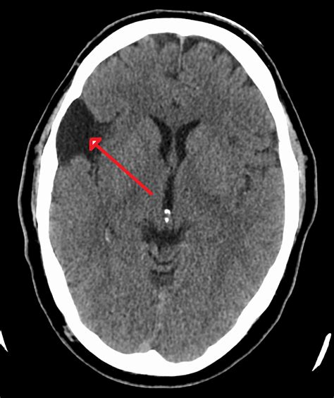 Arachnoid cyst .